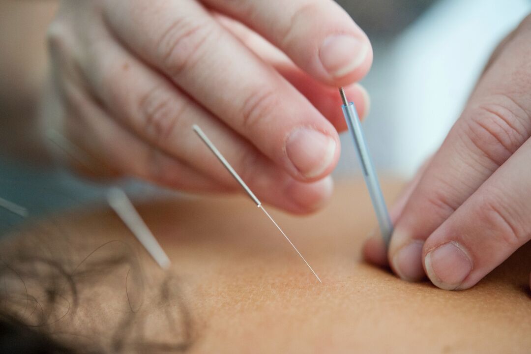 Acupuncture is an ineffective way to quit smoking